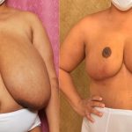 Breast Reduction Before & After Patient #13991