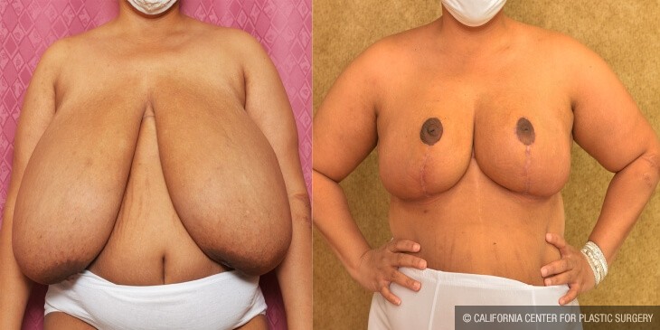 Breast Reduction Before & After Patient #13991