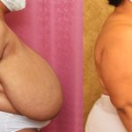 Breast Reduction Before & After Patient #13991