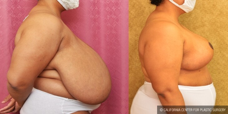 Breast Reduction Before & After Patient #13991