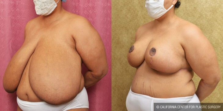 Breast Reduction Before & After Patient #13991