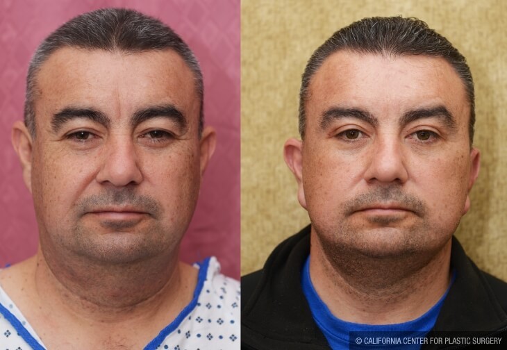 Male Neck & Face Liposuction Before & After Patient #13996