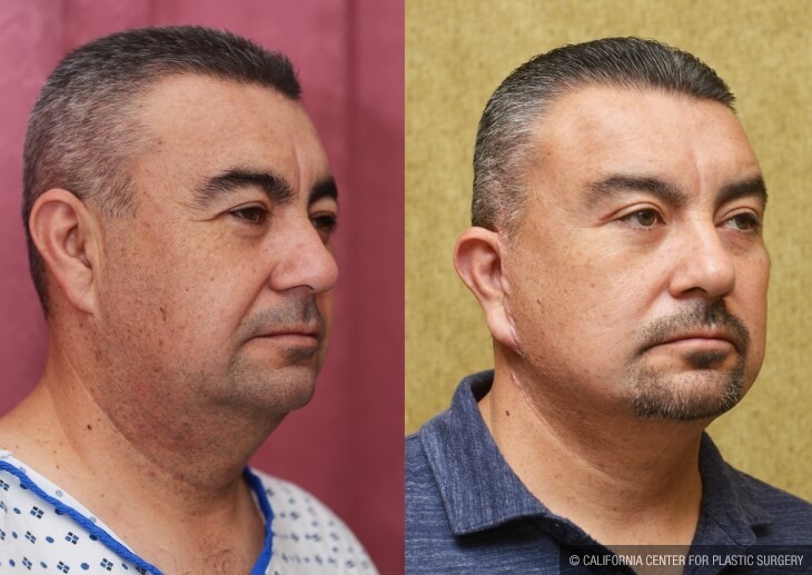 Male Neck & Face Liposuction Before & After Patient #13996