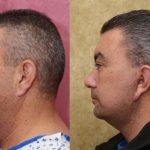 Male Neck & Face Liposuction Before & After Patient #13996