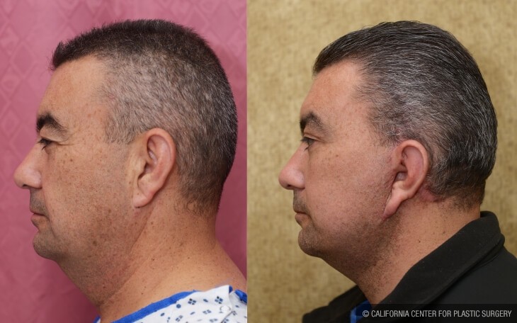 Male Neck & Face Liposuction Before & After Patient #13996