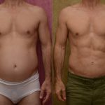 Liposuction Abdomen Medium Before & After Patient #13983