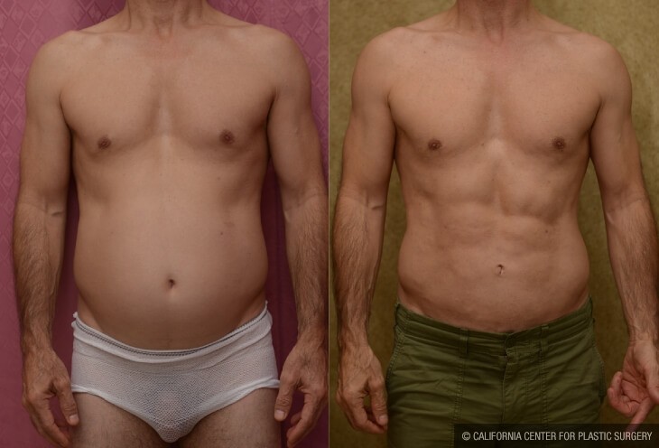 Liposuction Abdomen Medium Before & After Patient #13983
