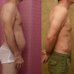 Liposuction Abdomen Medium Before & After Patient #13983