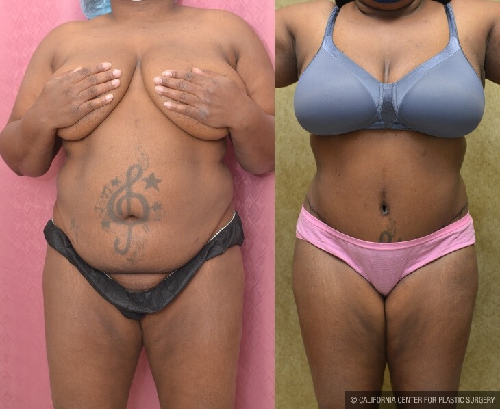 Tummy Tuck (Abdominoplasty) Plus Size Before & After Patient #14029