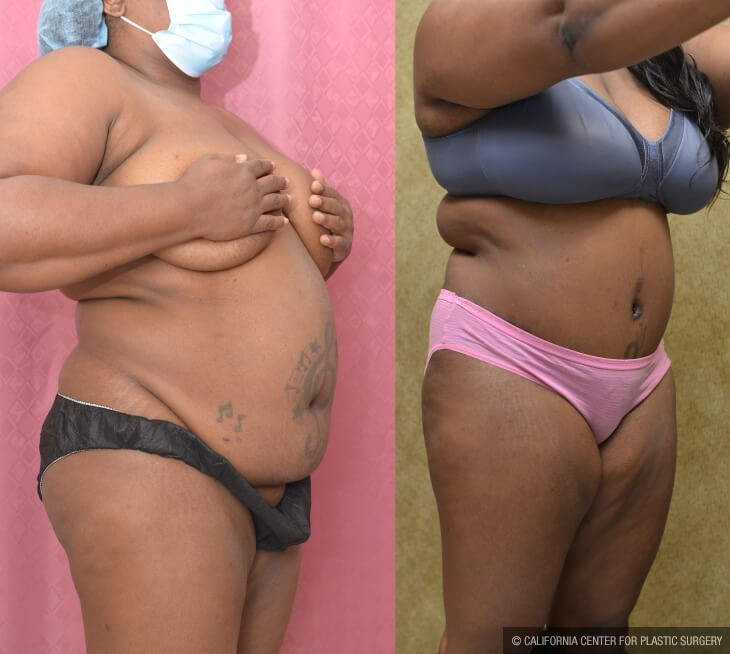 Tummy Tuck (Abdominoplasty) Plus Size Before & After Patient #14029