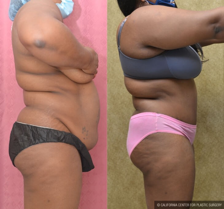 Tummy Tuck (Abdominoplasty) Plus Size Before & After Patient #14029