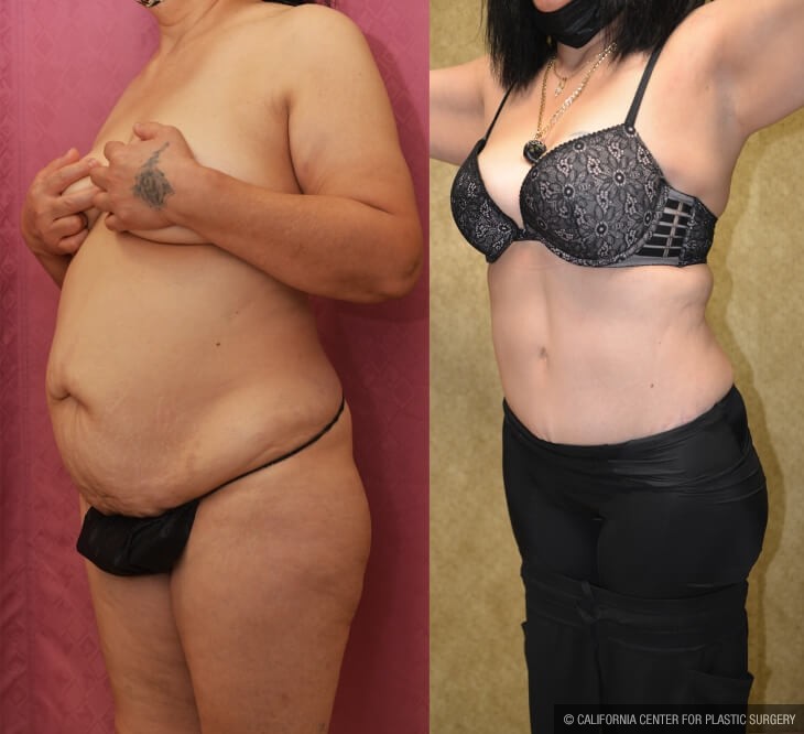 Tummy Tuck (Abdominoplasty) Medium Size Before & After Patient #14033