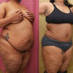 Tummy Tuck (Abdominoplasty) Plus Size Before & After Patient #14037