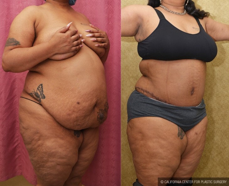 Plus Size Tummy Tuck: High BMI Tummy Tuck