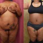 Tummy Tuck (Abdominoplasty) Plus Size Before & After Patient #14037