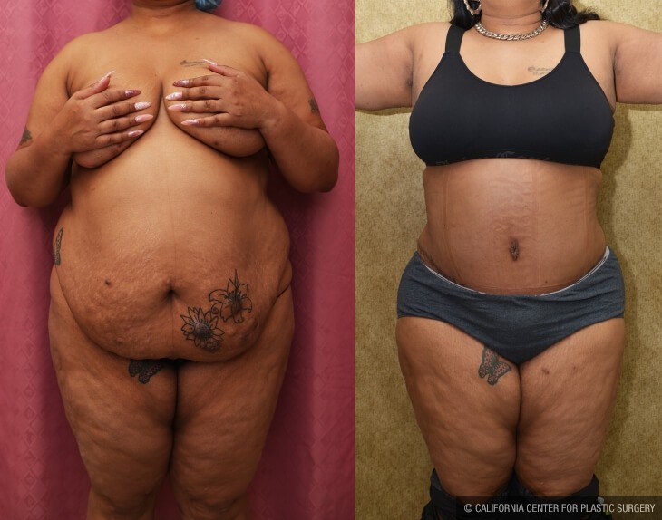 Tummy Tuck (Abdominoplasty) Plus Size Before & After Patient #14037
