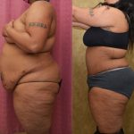 Tummy Tuck (Abdominoplasty) Plus Size Before & After Patient #14037