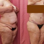 Tummy Tuck (Abdominoplasty) Plus Size Before & After Patient #14041