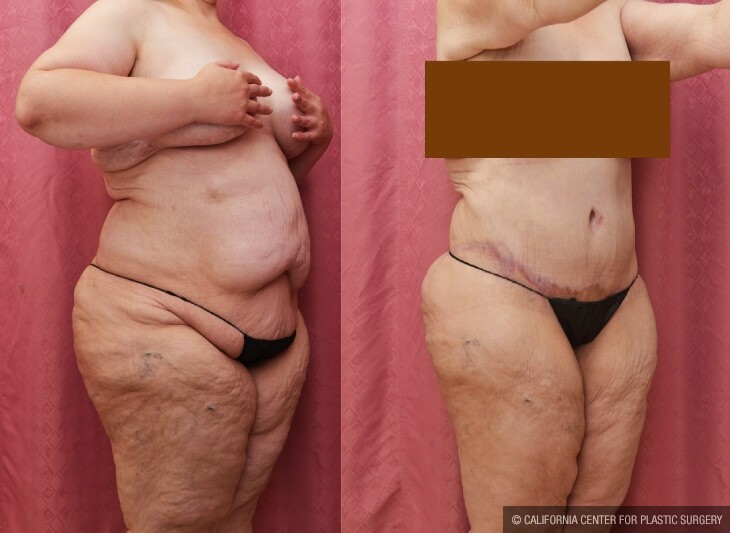 Tummy Tuck (Abdominoplasty) Plus Size Before & After Patient #14041