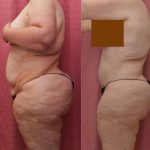 Tummy Tuck (Abdominoplasty) Plus Size Before & After Patient #14041