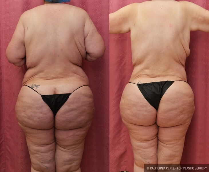 Tummy Tuck (Abdominoplasty) Plus Size Before & After Patient #14041
