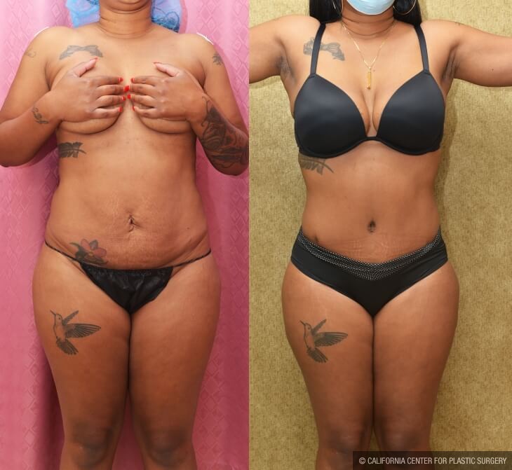Tummy Tuck (Abdominoplasty) Small Size Before & After Patient #14046