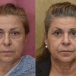 Eyelid (Blepharoplasty) Before & After Patient #13995