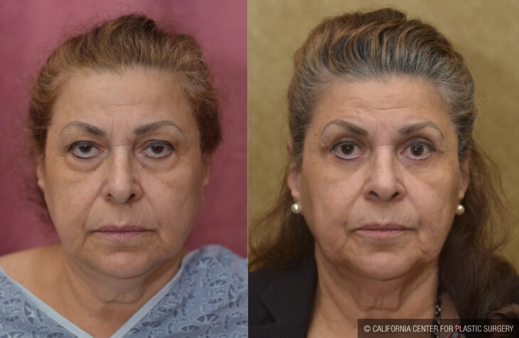 Eyelid (Blepharoplasty) Before & After Patient #13995