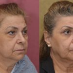 Eyelid (Blepharoplasty) Before & After Patient #13995