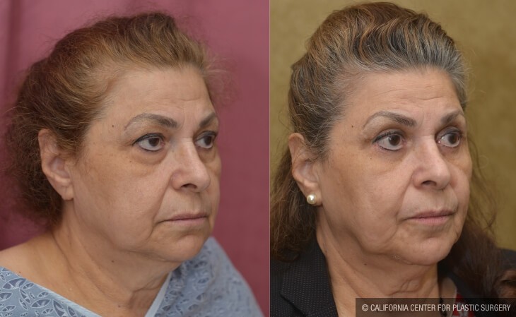 Eyelid (Blepharoplasty) Before & After Patient #13995