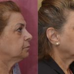 Eyelid (Blepharoplasty) Before & After Patient #13995