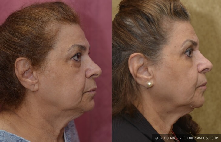 Eyelid (Blepharoplasty) Before & After Patient #13995