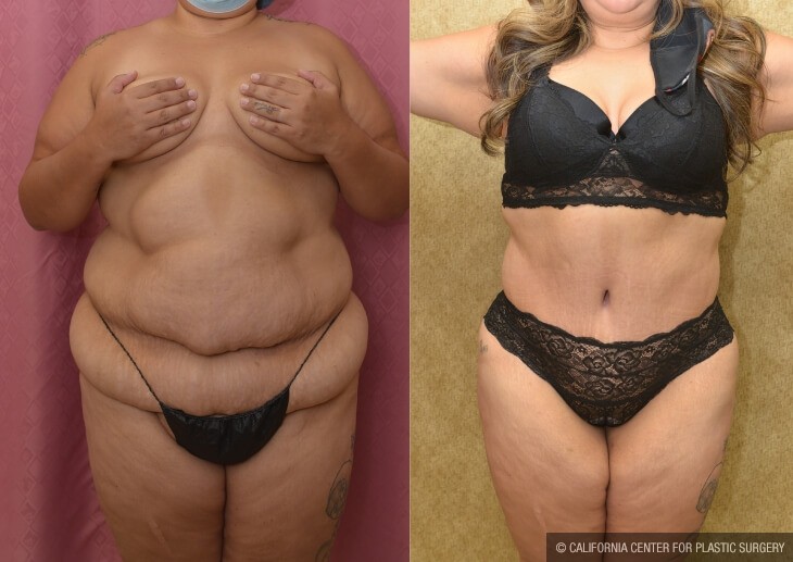 Tummy Tuck (Abdominoplasty) Plus Size Before & After Patient #13997