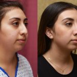 Rhinoplasty - Middle Eastern Before & After Patient #13998