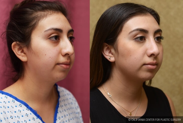 Rhinoplasty - Middle Eastern Before & After Patient #13998