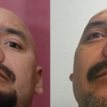 Rhinoplasty - Hispanic Before & After Patient #14020