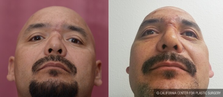 Rhinoplasty - Hispanic Before & After Patient #14020