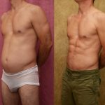 Male Liposuction Abdomen Before & After Patient #14108