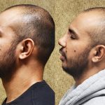 Rhinoplasty - Hispanic Before & After Patient #14119