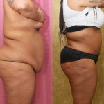 African American Tummy Tuck (Abdominoplasty) Before & After Patient #14090