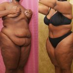 Tummy Tuck (Abdominoplasty) Plus Size Before & After Patient #14095