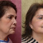 Facelift Before & After Patient #14102