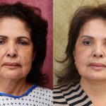 Facelift Before & After Patient #14102