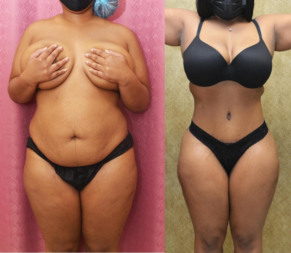 Tummy Tuck (Abdominoplasty) Small Size Before & After Patient #14107
