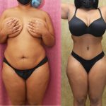 Tummy Tuck (Abdominoplasty) Small Size Before & After Patient #14107