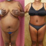 African American Tummy Tuck (Abdominoplasty) Before & After Patient #14106