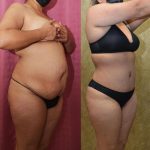 Tummy Tuck (Abdominoplasty) Small Size Before & After Patient #14089