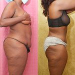 African American Tummy Tuck (Abdominoplasty) Before & After Patient #14155