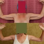 Arm Lift (Brachioplasty) Before & After Patient #14260