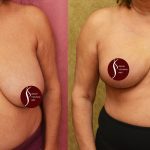Breast Reduction Before & After Patient #14259